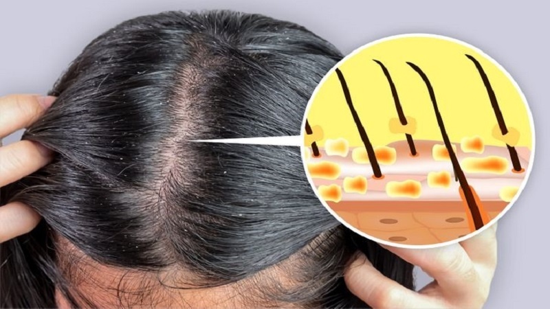 Dầu gội trị gàu - Điểm danh 6 dầu gội trị gàu hiệu quả